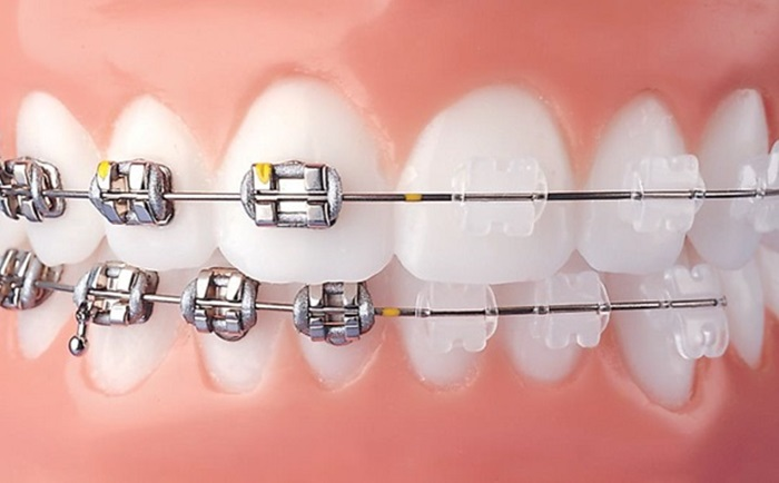 Niềng răng có tốt không? Các vấn đề thường gặp khi niềng răng bạn lên lưu ý